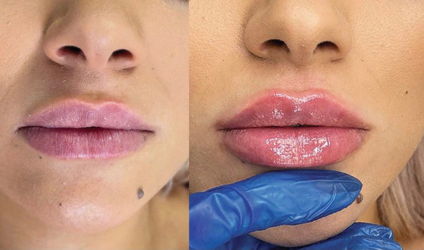 Totul despre tehnicile exclusive de injectare a buzelor:  Russian Lips, Kendall Lips sau Kylie Lips