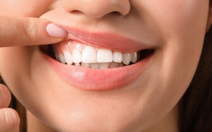 Zâmbetul inestetic își găsește rezolvarea.. la estetician!  Ce este Gummy Smile și cum se tratează?
